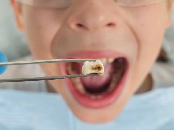 Best Emergency Dental Care for Abscessed Tooth in Grandview, IL